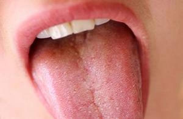 رائحة الفم الكريهة: الأسباب والعلاج