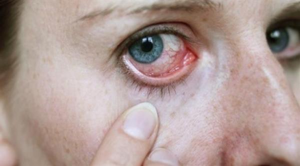 إهمال علاج هربس العيون يُهدد بالعمى