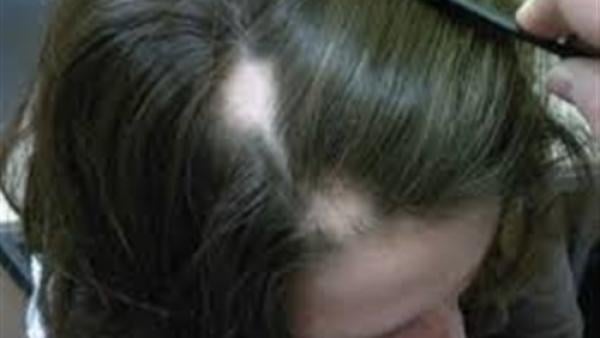3 وصفات طبيعية لعلاج الثعلبة ونمو الشعر من جديد