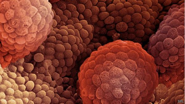 اختبارات سرطان البروستاتا لا تظهر نصف حالات الإصابة