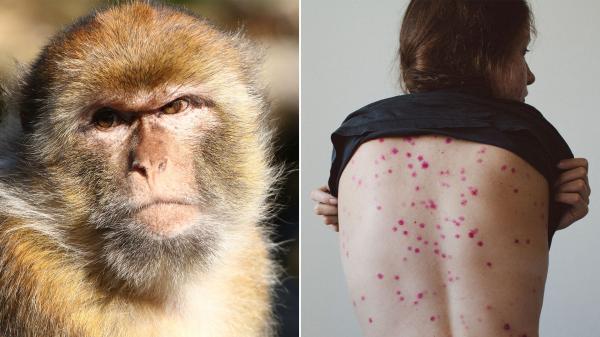 المملكة المتحدة: ظهور 16 حالة جديدة من جدري القردة