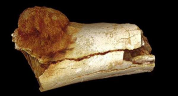 بالفيديو.. اكتشاف أقدم ورم سرطاني في عظام أشباه للبشر منذ مليوني عام