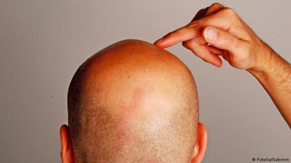دواء جديد للثعلبة يبعث الأمل لمن يعانون من تساقط الشعر