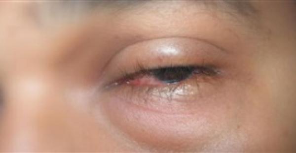 3 أسباب تؤدي إلى إصابة العيون بالانتفاخ