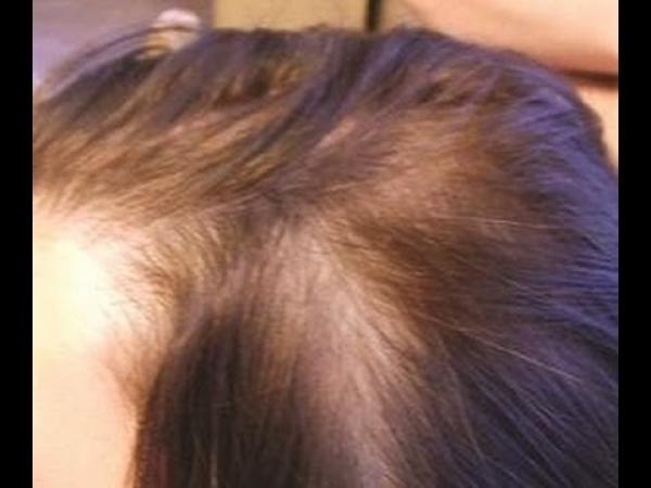وصفات لعلاج الشعر الخفيف