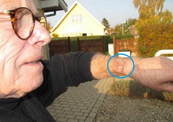 بالصور: احترقت يده بسبب ساعة أبل الذكية