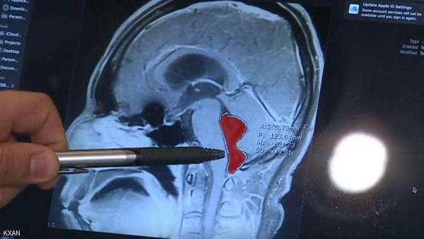 فحوصات تكشف عن دودة شريطية داخل دماغ رجل استقرت في موقعها  10 سنوات