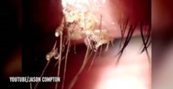 بالفيديو.. لقطات مروعة لـ«قمل» ينمو على رموش العين