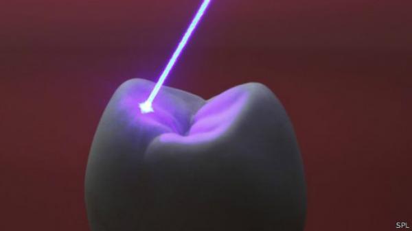الليزر "قد يجنب" المرضى الحاجة لعلاج جذور الأسنان