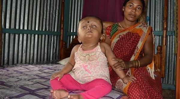 بالصور: الطفلة "المعجزة" تتحدى الأطباء في الهند