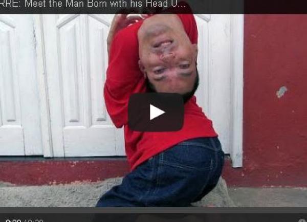 بالفيديو: رجل برازيلي يعيش برأس "مقلوب"
