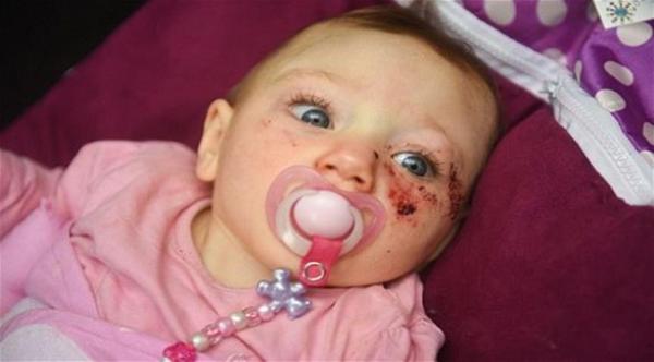 طفلة تولد بدماغ ينمو خارج جسمها تتحدى توقعات الأطباء
