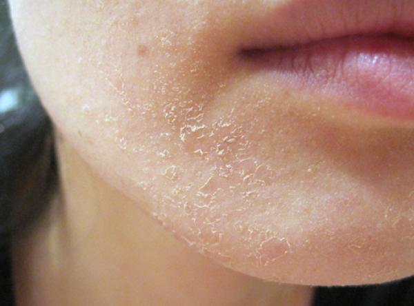 أسباب وعلاج مشكل جفاف بشرة الوجه