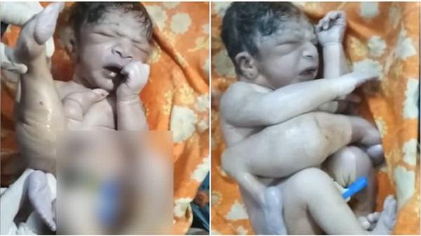 بالفيديو: طفل يولد بـ4 سيقان و3 أذرع في الهند