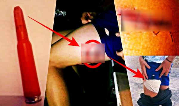 غليان بالفيسبوك بعد إقدام شرطي إسباني على إطلاق رصاصة أصابت قاصرا مغربيا على مستوى فخذه (صور)
