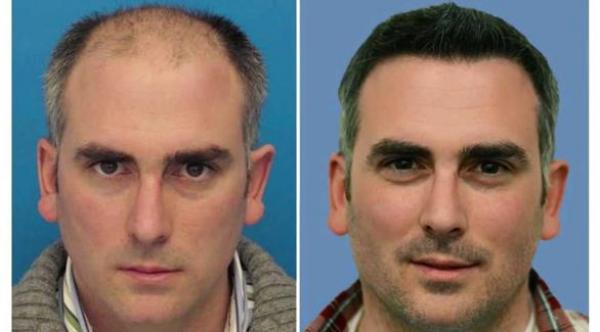 دراسة: زراعة الشعر تجعل الرجال يبدون أكثر جاذبية وأصغر سناً