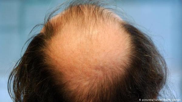 ارتفاع حالات تساقط الشعر في زمن كورونا.. كيف يمكنك الحفاظ على صحتة واستعادة المتساقط منه