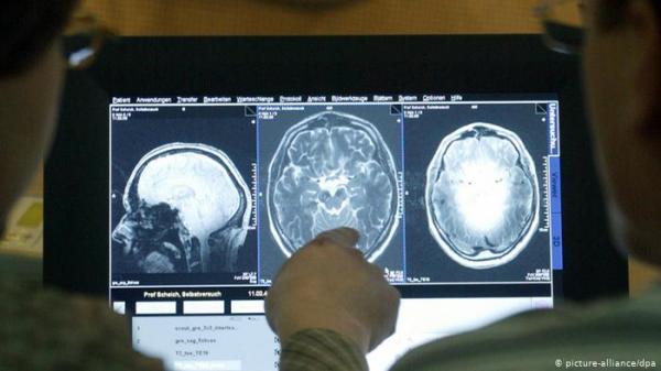 جهاز جديد يقلل فقدان الذاكرة لدى مرضى الزهايمر