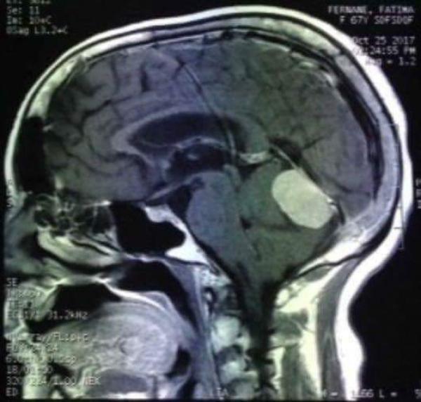 أطباء بمستشفى خنيفرة يتمكنون من استئصال ورم داخل الدماغ لمسنة عمرها 60 سنة في عملية دامت أزيد من 11 ساعة