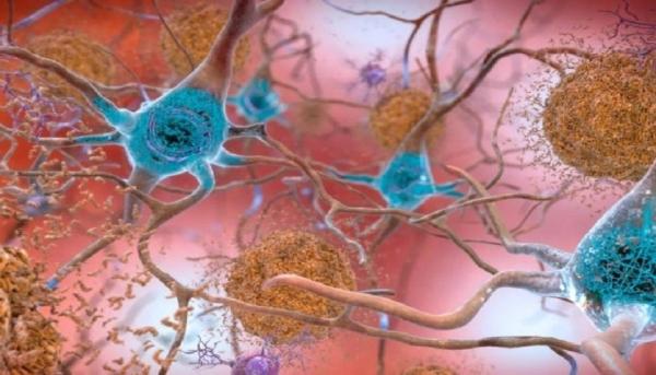 كيف تموت خلايا الدماغ أثناء مرض ألزهايمر؟