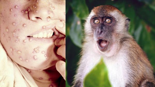 باحثة تُطمئن العالم:"جذري القردة لن يتطور الى مرحلة وباء عالمي"