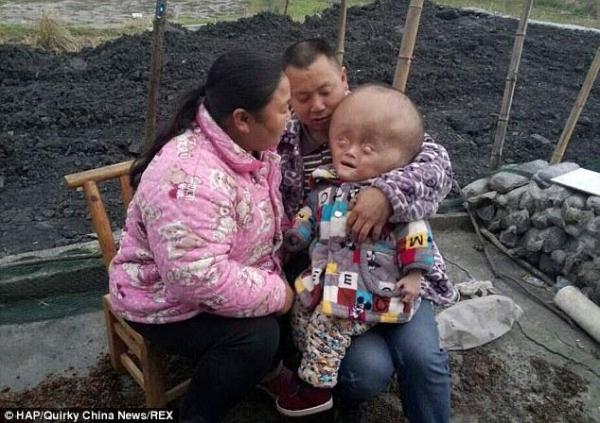 بالصور .. طفل صيني مصاب بمرض نادر يجعل رأسه تنمو بشكل مستمر