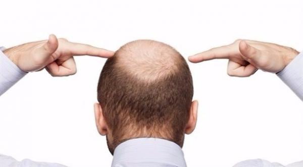 دراسة: أدوية منع تساقط الشعر قد تسبّب العجز الجنسي