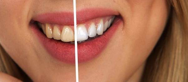 ستة أخطاء شائعة تسبب اصفرار الأسنان