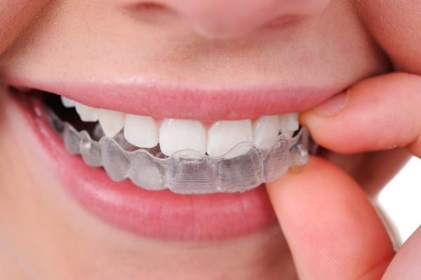 تقويم الأسنان لا يرتبط بسن معين