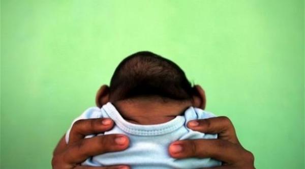 إسبانيا تسجل ولادة أول رضيع مصاب بصغر الرأس في أوروبا