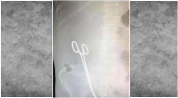 "مقص" في بطن مريض بمستشفى بالسعودية