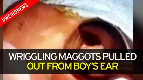 بالفيديو: جراح يخرج 14 يرقة حية من أذن صبي
