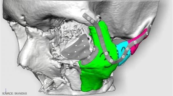 أطباء صينيون يزرعون عظاماً جديدة بتقنية الطباعة ثلاثية الأبعاد