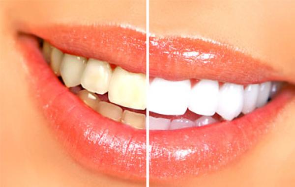 وصفات تبييض الاسنان والتخلص من اصفرارها