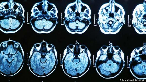 دراسة: تصويرهوليوود للموت الدماغي غير صحيح