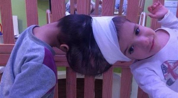 فصل توأم سيامي سوري ملتصق من الرأس