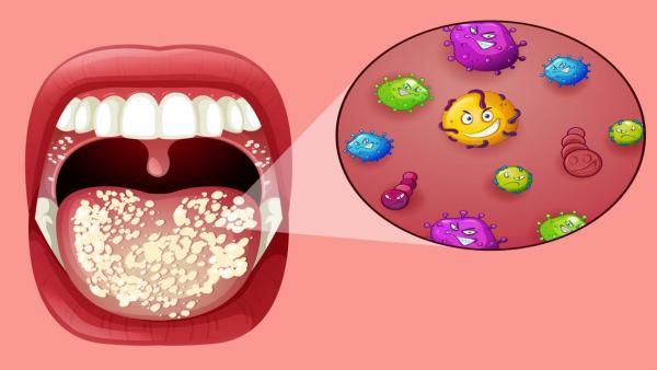 علاج فطريات الفم عند الأطفال والكبار