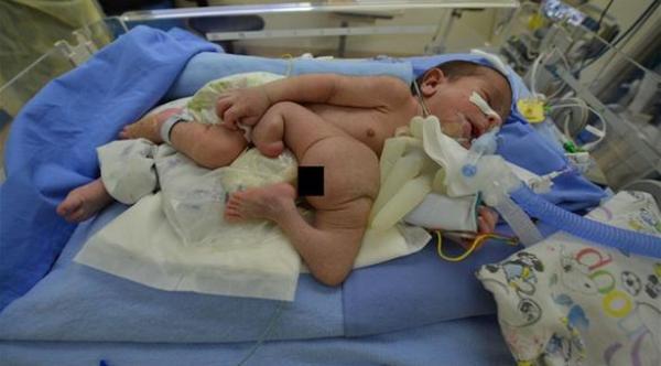 طفل مصري يولد مع توأم طفيلي بدون رأس في الرياض
