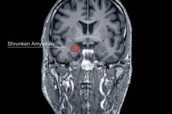 خبراء يجرون اختبارات على دماغ قاتل لمعرفة الأسباب التي تدفع الإنسان لارتكاب الجريمة