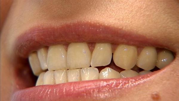 مشكلة صرير الأسنان وتأثيرها على أوجاع الرأس والمفاصل!