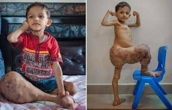 بالفيديو: ساق طفل تنمو 4 أضعاف حجمها الطبيعي