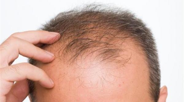 7 عادات يومية تسبب تساقط الشعر