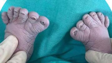 امرأة تثير دهشة الأطباء وتنجب للمرة الثالثة طفلا بـ12 أصبعا في قدميه!