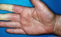 متلازمة رينود: عندما يحوّل البرد الأصابع إلى جثث!