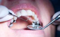 بيلاروسيا تبدأ تطوير لقاح مضاد لتسوس الأسنان