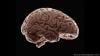 الإصابات الخفيفة في الدماغ الخفيفة يمكن أن تتسبب في التدهور المعرفي المبكر