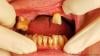 فقدان عدد كبير من الأسنان من مؤشرات الإصابة بالخرف