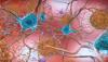 كيف تموت خلايا الدماغ أثناء مرض ألزهايمر؟