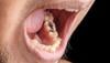 البرلمان الأوروبي يقرر منع استخدام حشوات الأسنان الزئبقية